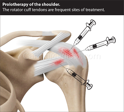 http://www.hauserdiet.com/wp-content/uploads/2022/09/shoulder-prolotherapy-WEB.png